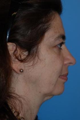 Facelift Before & After Image