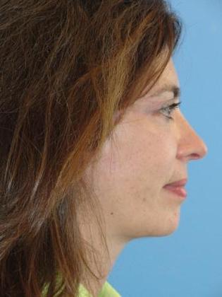 Facelift Before & After Image