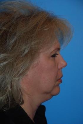 Facelift Before & After Image