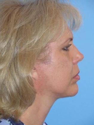 Facelift Before & After Image