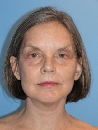 Facelift Before & After Image