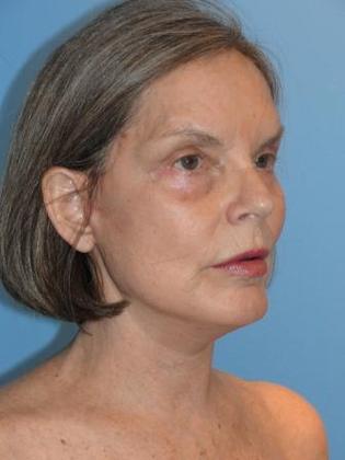 Facelift Before & After Image