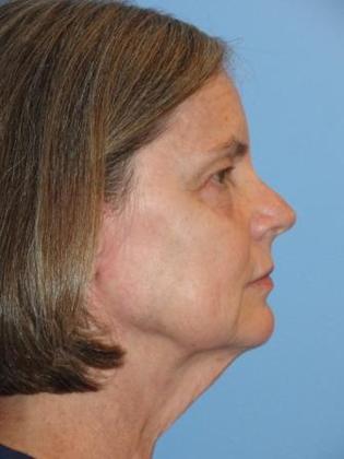 Facelift Before & After Image