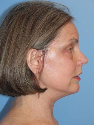 Facelift Before & After Image