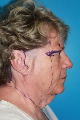 Facelift Before & After Image