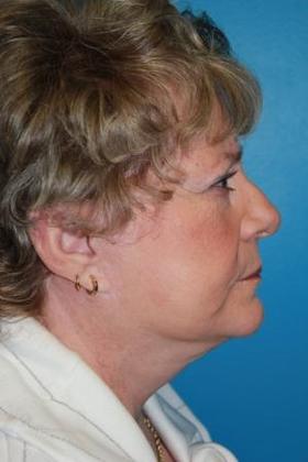 Facelift Before & After Image