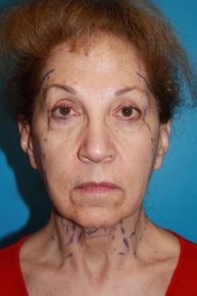 Facelift Before & After Image