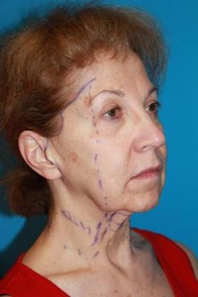 Facelift Before & After Image