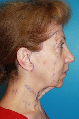 Facelift Before & After Image