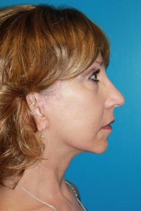 Facelift Before & After Image