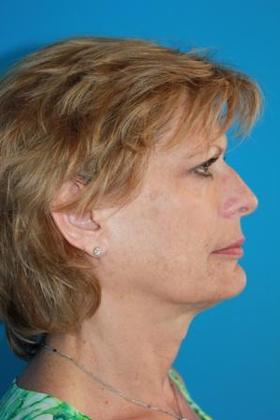 Facelift Before & After Image