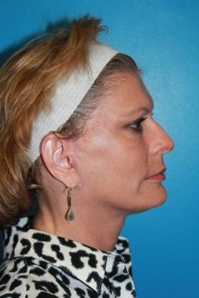 Facelift Before & After Image