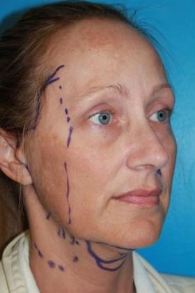 Facelift Before & After Image