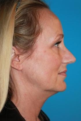 Facelift Before & After Image