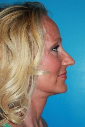 Facelift Before & After Image