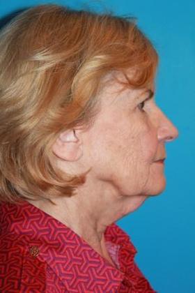 Facelift Before & After Image