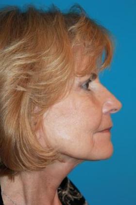 Facelift Before & After Image