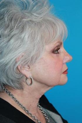 Facelift Before & After Image