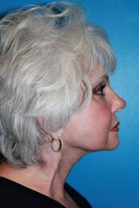 Facelift Before & After Image