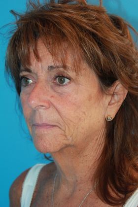 Facelift Before & After Image