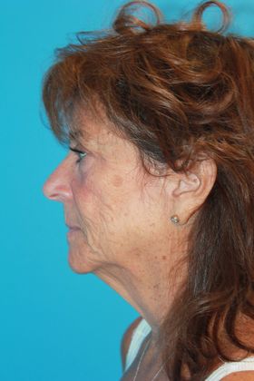 Facelift Before & After Image