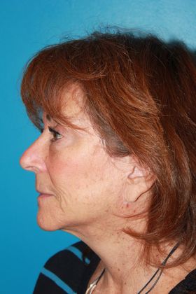 Facelift Before & After Image