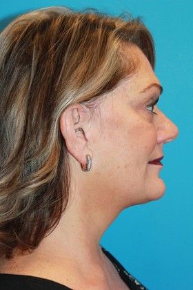 Facelift Before & After Image