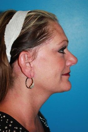 Facelift Before & After Image