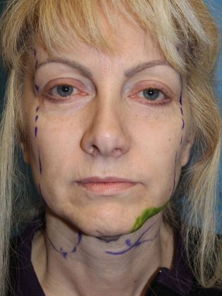 Facelift Before & After Image