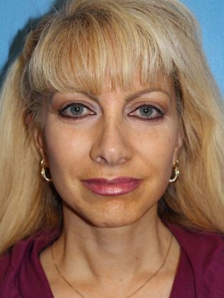 Facelift Before & After Image