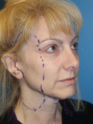 Facelift Before & After Image