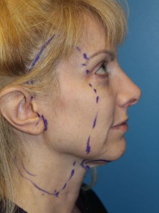 Facelift Before & After Image