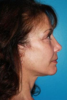Lipoaugmentation Before & After Image