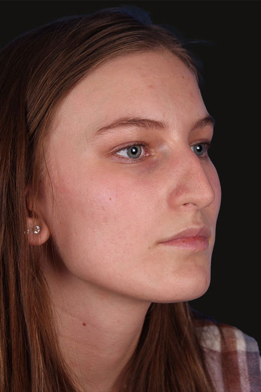 Rhinoplasty Before & After Image