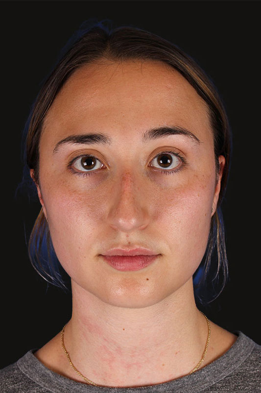 Rhinoplasty Before & After Image