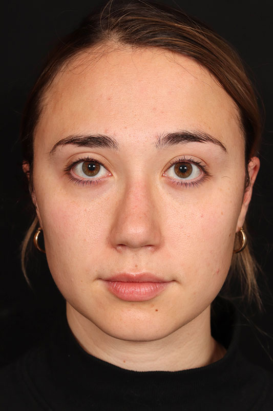 Rhinoplasty Before & After Image