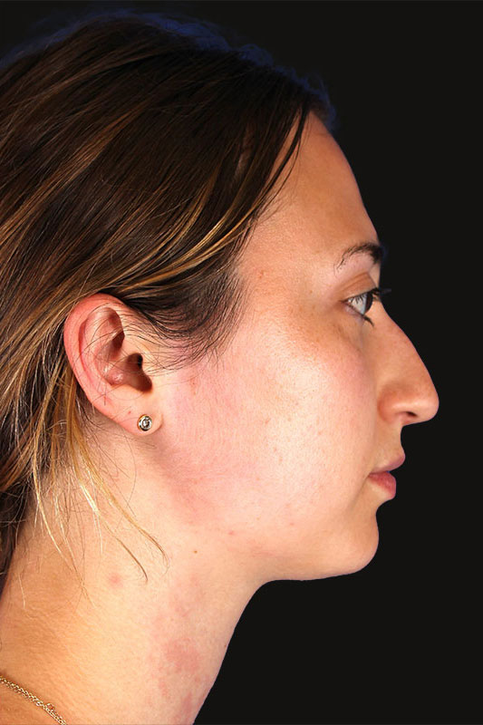 Rhinoplasty Before & After Image