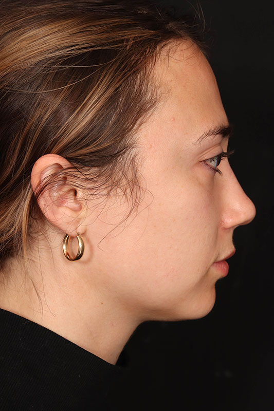 Rhinoplasty Before & After Image