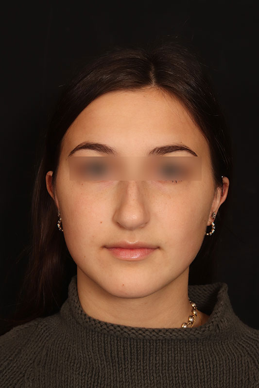 Rhinoplasty Before & After Image