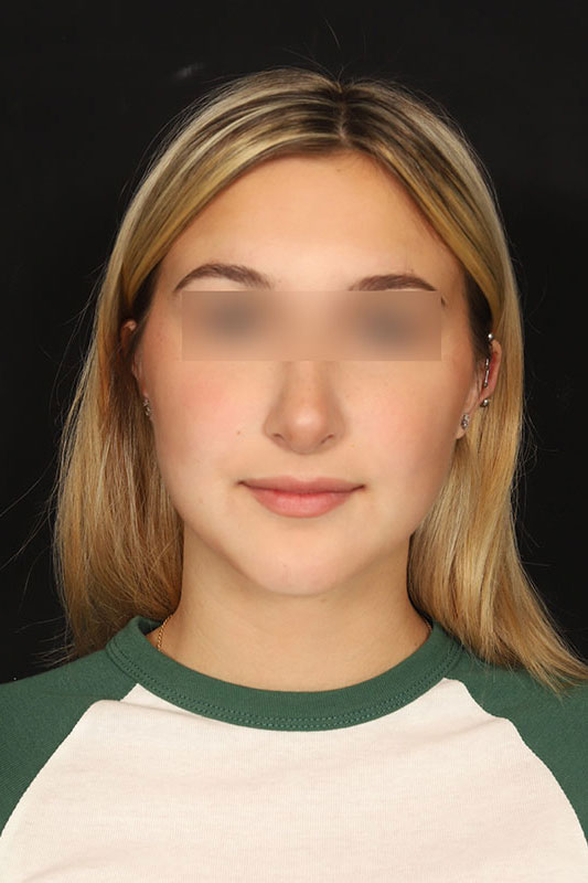 Rhinoplasty Before & After Image