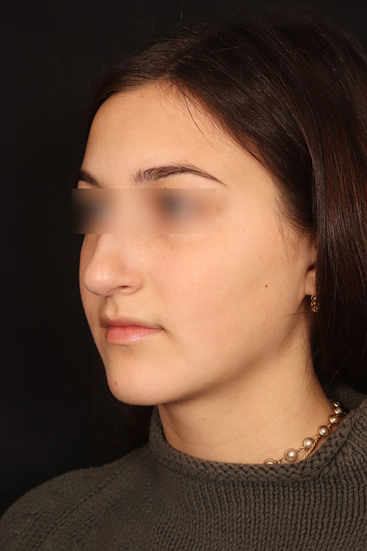 Rhinoplasty Before & After Image