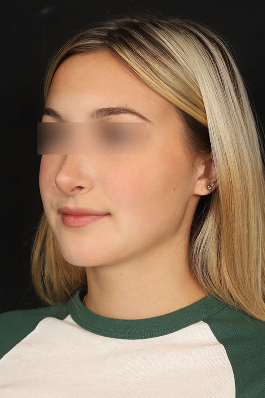 Rhinoplasty Before & After Image