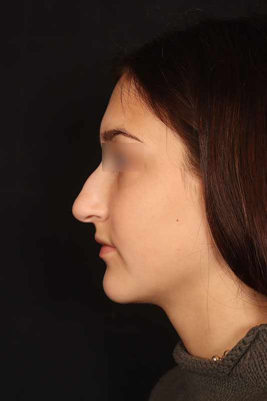 Rhinoplasty Before & After Image