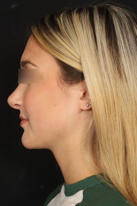 Rhinoplasty Before & After Image